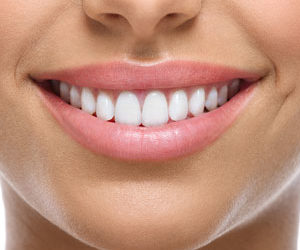 Dental Veneers