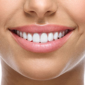 Dental Veneers