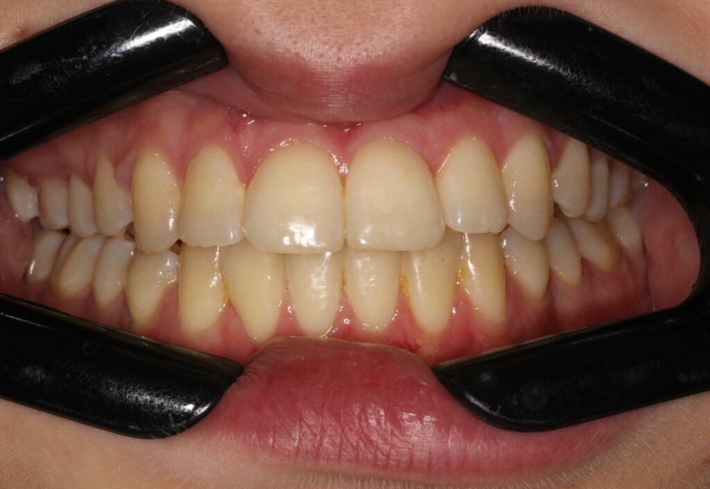 Traditional Braces Smile House