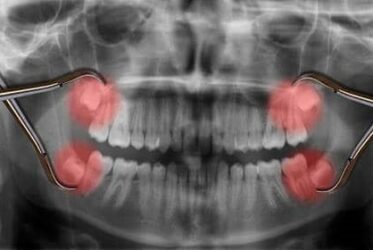 X-RAY for wisdom teeth removal