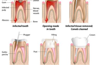 Root Canal Therapy (Diagram)