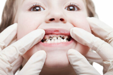 Common dental problems with children's teeth