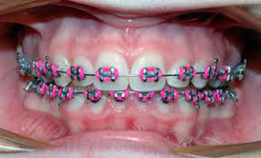Close up of Traditional Braces (Pink)