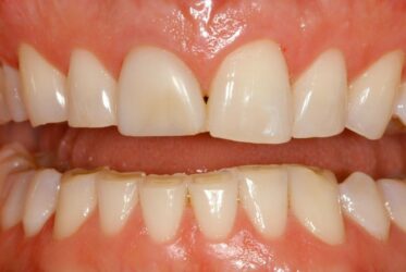 Example how how teeth can look through teeth grinding