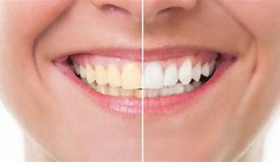 Teeth whitening (before and after shot)