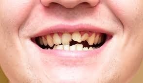 Close up of broken teeth from injuries or falls